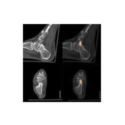 Foot support for SPECT/CT - PET/CT