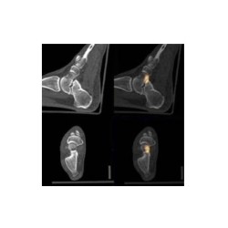 Voetsteun voor SPECT/CT - PET/CT