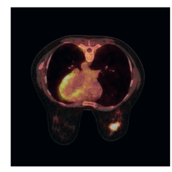 Borstkussen voor onderzoek in buiklig tijdens PET/CT onderzoeken