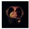 Borstkussen voor onderzoek in buiklig tijdens PET/CT onderzoeken